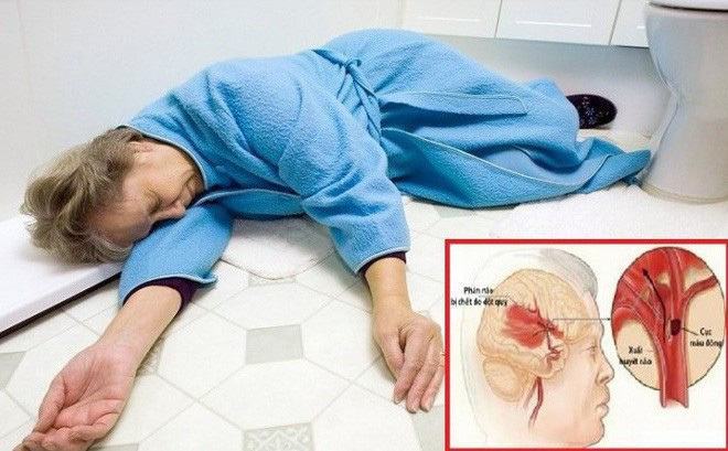 Mỗi năm có 100.000 người tử vong do đột quỵ