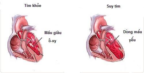 Cứu sống một bệnh nhân bị suy tim nặng