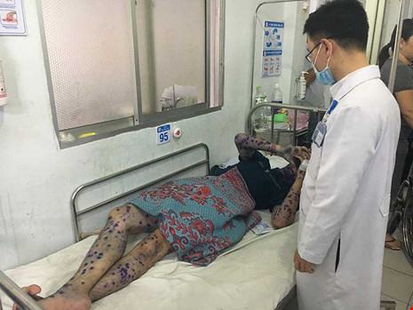 Ráo riết xử lý ổ dịch thủy đậu tại khu chế xuất