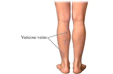 Càng cao càng dễ bị suy giãn tĩnh mạch