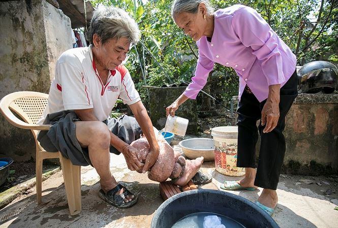 WHO công nhận VN loại trừ bệnh giun chỉ bạch huyết