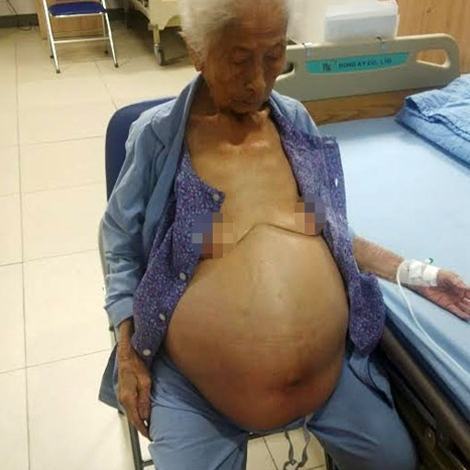 Cụ ông 84 tuổi được cắt khối u trên 10kg