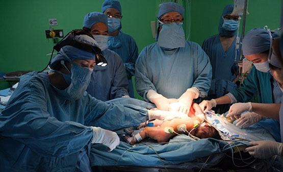 Phẫu thuật tách rời cặp song sinh dính liền phần bụng
