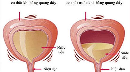 Bớt khổ vì tiểu không tự chủ