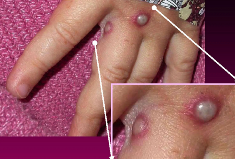 Bệnh hiếm đậu mùa khỉ xuất hiện ở châu Âu, lan đến Mỹ