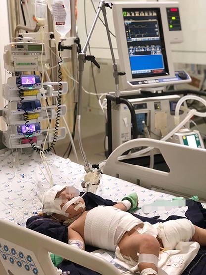 Phỏng nước sôi do vướng dây điện ấm đun siêu tốc