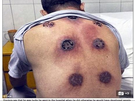 Bị nhiễm trùng nặng do giác hơi ở Trung Quốc - ảnh 1