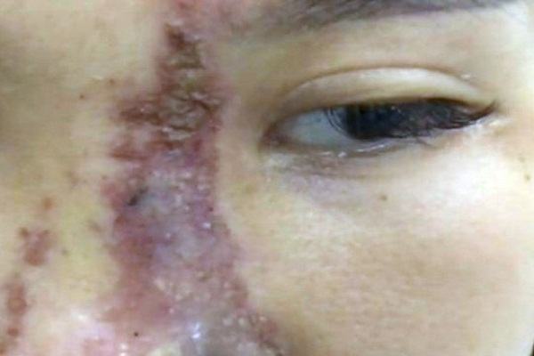 Nữ sinh 19 tuổi bị hoại tử mũi sau khi làm đẹp