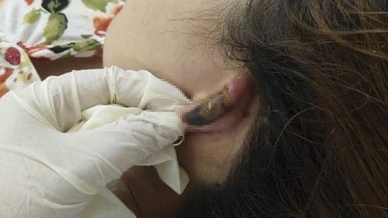 Bỏng sâu khi đi làm đẹp