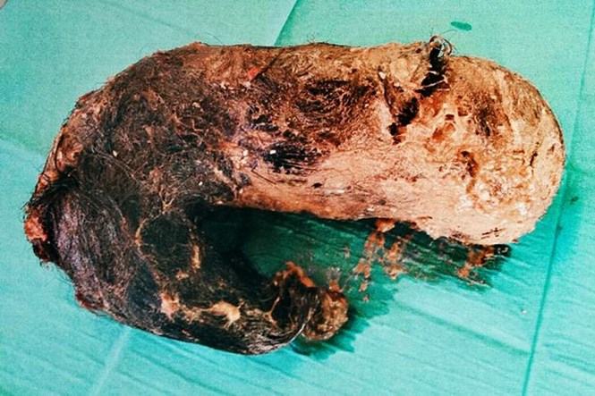 Búi tóc nặng 1,4 kg trong bụng của một cô gái vì thói quen nhai tóc