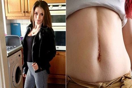 Búi tóc nặng 1,4 kg trong bụng của một cô gái vì thói quen nhai tóc - ảnh 2