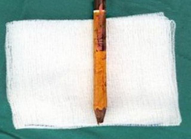 Một HS bị bút chì đâm sâu 8cm ở mông trái