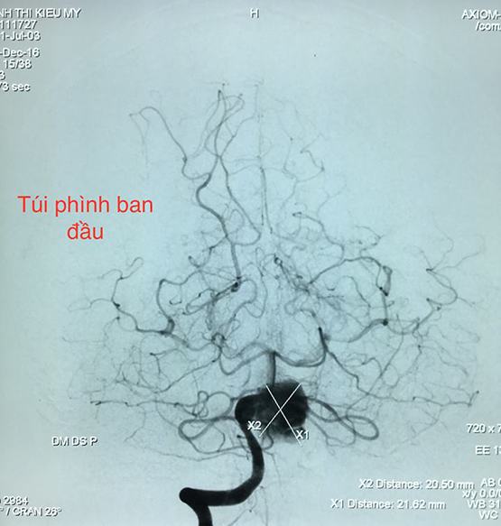 Lần đầu tiên bệnh nhân được can thiệp mạch máu khi tỉnh táo