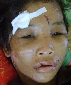 Cà Mau: Nỗi niềm mẹ con cháu bé bị hành hạ như thời trung cổ