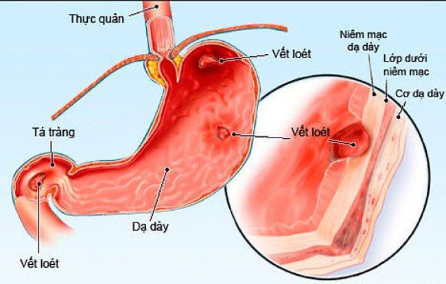 Viêm loét dạ dày