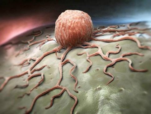 Cảnh báo ung thư tăng mạnh ở phụ nữ, nhiều nhất là ung thư vú - ảnh 1