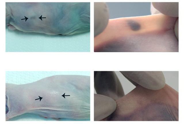 Cấy nốt ruồi dưới da để phát hiện sớm ung thư