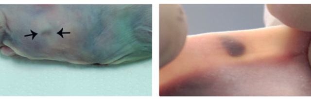 Cấy nốt ruồi dưới da để phát hiện sớm ung thư - Ảnh 2.