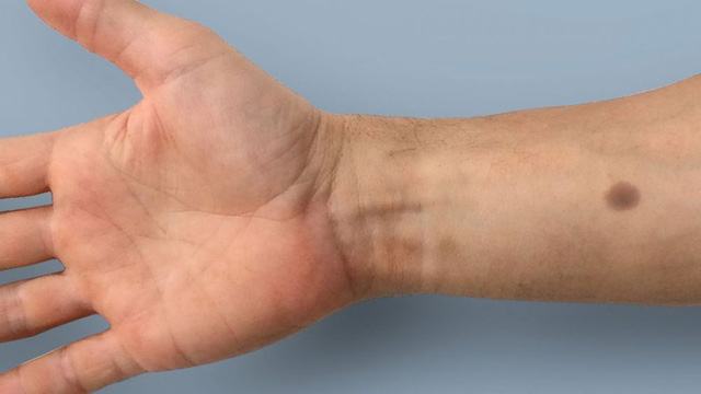 Cấy nốt ruồi dưới da để phát hiện sớm ung thư - Ảnh 3.