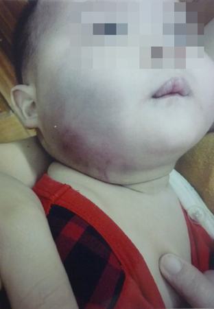 Đà Nẵng: Thêm một cháu bé nghi bị bạo hành ở nhà trẻ tư