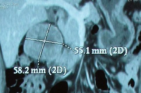 Chỉ đau lưng, đau bụng, khám ra… ung thư - ảnh 2