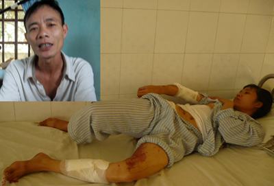 Có thể khởi tố kẻ tạt nồi canh nóng vào người vợ