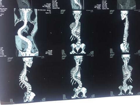 Phẫu thuật thành công cho thiếu nữ có xương sống hình rắn