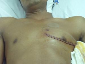 Cứu sống nạn nhân bị mảnh kính đâm thủng tim