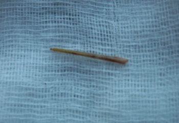 Đà Nẵng: Một vụ hóc xương cá vô cùng hy hữu