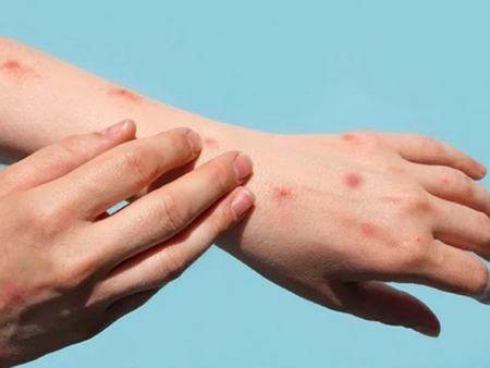 Đã có kết quả giải mã gene của trường hợp mắc bệnh Mpox