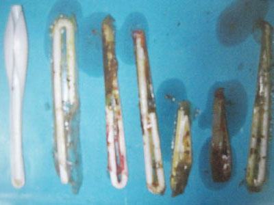 Giận chồng, nuốt 6 ống hút, 1 thìa nhựa