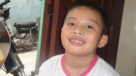 Học sinh Nguyễn L&ecirc; Ho&agrave;ng Long (lớp 2/7) bị c&ocirc; gi&aacute;o đ&aacute;nh g&atilde;y mất răng (Nguồn Bee)