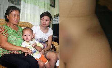 Hà Nội: Phụ huynh “tố” cô giáo đánh trẻ bầm dập chỗ kín