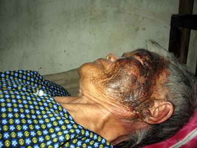 Hà Tĩnh: Nàng dâu hắt phích nước sôi vào mặt mẹ chồng