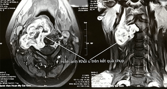 Phẫu thuật thành công cho người phụ nữ bị khối u hiếm gặp