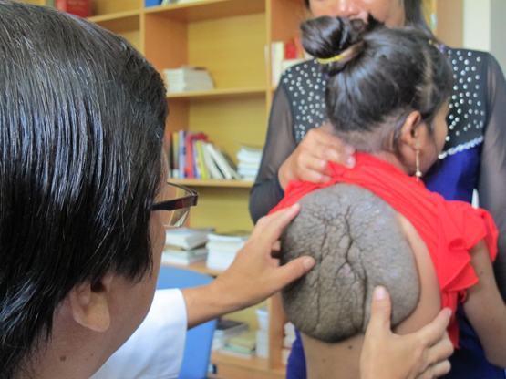 Trường hợp đầu tiên ở Việt Nam mang “mai rùa” trên lưng