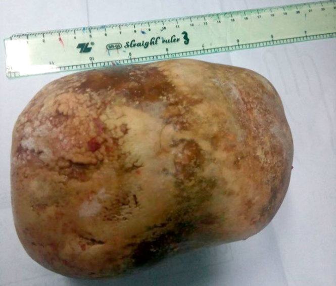 Mổ lấy sỏi bàng quang nặng 1,5kg 