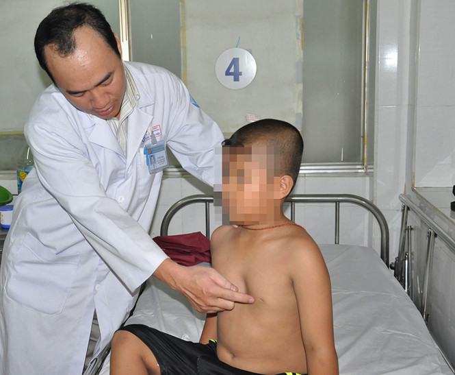 Mùa hè trẻ nhập viện mổ ngực lõm tăng gấp đôi