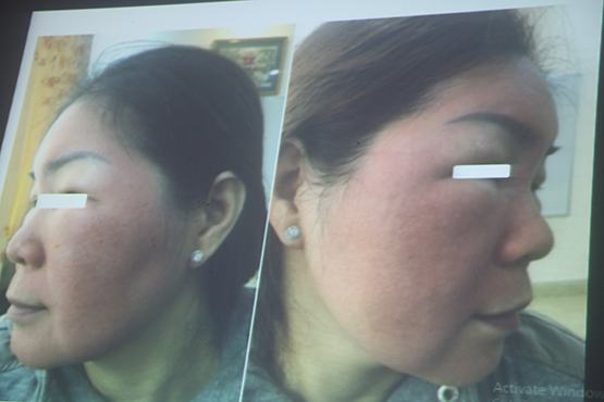 Vì mỹ phẩm thuốc Đông Y… gây biến chứng!