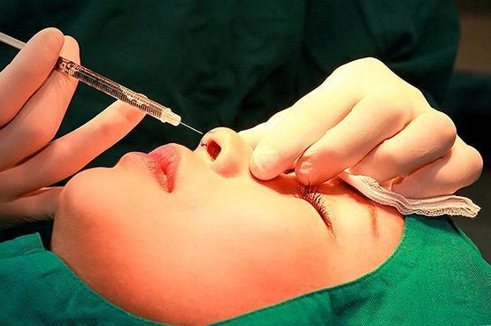 Gặp họa vì tiêm filler nâng mũi