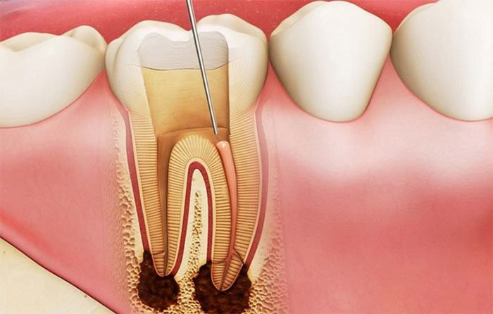 Viêm lợi nếu không được điều trị đúng sẽ có những biến chứng có thể làm sâu răng, mất răng.