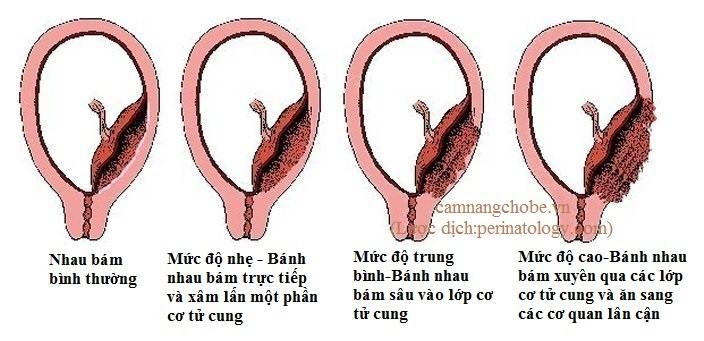 Cần phát hiện sớm bệnh nhau cài răng lược
