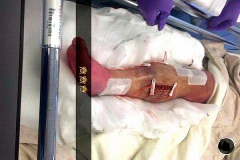 Nhoi long voi hinh anh chan Luke Shaw sieu bien dang sau phau thuat hinh anh