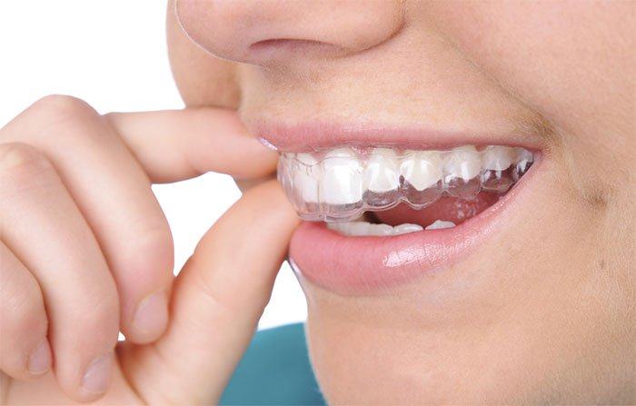 Những điều chưa biết về niềng răng trong suốt Invisalign