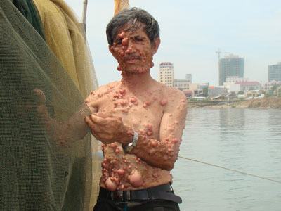Những khối u phiền toái của ông Sáu “dị nhân”