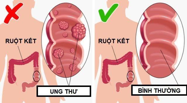 Hạn chế nguy cơ mắc ung thư