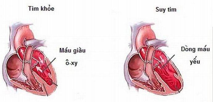 Tim khỏe và suy tim