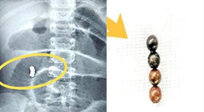 Lấy 4 viên bi nam châm trong bụng bé gái 6 tuổi