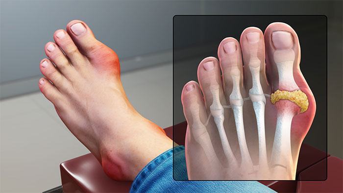 Bệnh Gout là một loại viêm khớp khác gây ra những cơn đau dữ dội