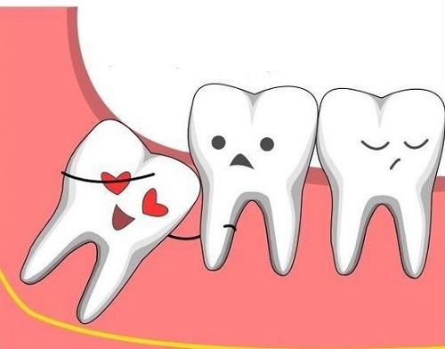 Không phải tất cả những chiếc răng khôn nào cũng cần phải loại bỏ.